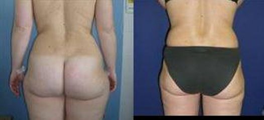 lipo5a