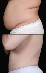 Padera slimlipo