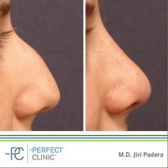 Plastika nosu (Rhinoplastika) - MUDr. Jiří Paděra - Perfect Clinic