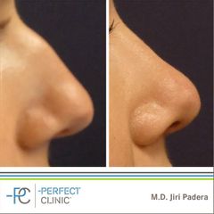Plastika nosu (Rhinoplastika) - MUDr. Jiří Paděra - Perfect Clinic