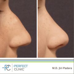 Rhinoplastika - MUDr. Jiří Paděra - Perfect Clinic
