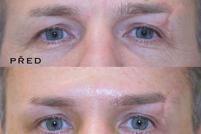 Brow lift před a po - 841731