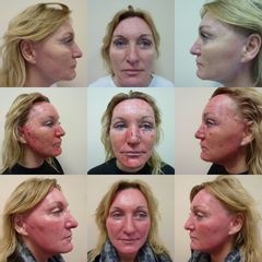 Chemicky peeling - Ústav estetické medicíny - Karlovy Vary