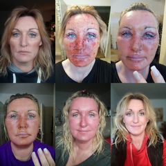 Chemicky peeling - Ústav estetické medicíny - Karlovy Vary