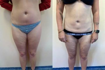 Liposukce - Ústav estetické medicíny - Karlovy Vary