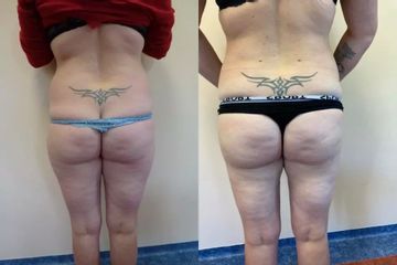 Liposukce - Ústav estetické medicíny - Karlovy Vary