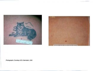 pigmentace tetování