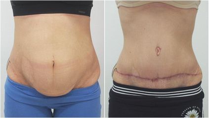 Abdominoplastika - MUDr. Pavel Popelka - MEDICOM Clinic