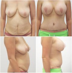 Modelace prsou s augmentací - MUDr. Pavel Popelka - MEDICOM Clinic