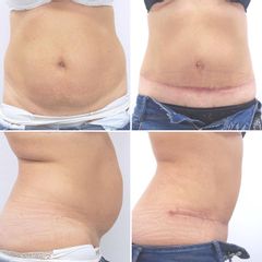 Abdominoplastika - MUDr. Pavel Popelka - MEDICOM Clinic