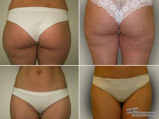 Liposukce - MUDr. Radek Lhotský