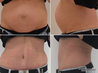 Abdominoplastika (Operace břicha) - MUDr. Radek Lhotský