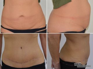 Abdominoplastika (Operace břicha) - MUDr. Radek Lhotský