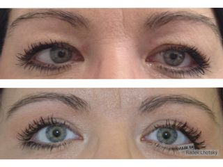 Operace očních víček (Blefaroplastika) - MUDr. Radek Lhotský