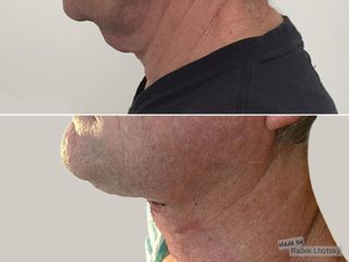 Facelift - MUDr. Radek Lhotský