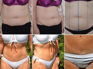 Abdominoplastika - MUDr. Radek Lhotský