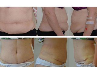 Abdominoplastika - MUDr. Radek Lhotský