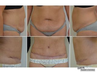 Abdominoplastika s liposukcí - MUDr. Radek Lhotský