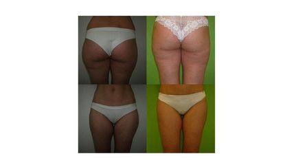 Liposukce fotky