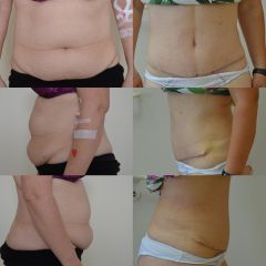 Před a po abdominoplastika
