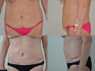 Abdominoplastika před a po