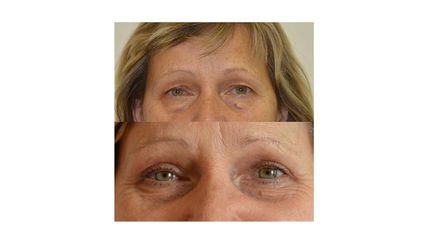 Blefaroplastika KK