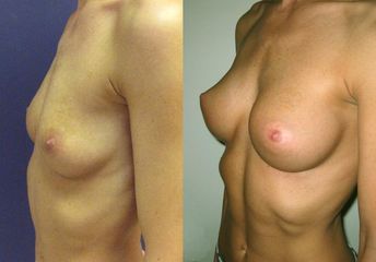 21B
