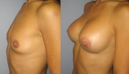 30B