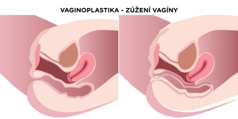 Vaginoplastika - MUDr. Zoja Čurilová Roháčová