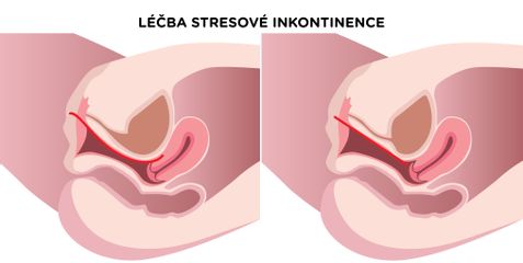 Léčba-stresové-inkontinence