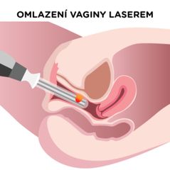 Omlazení vagíny laserem