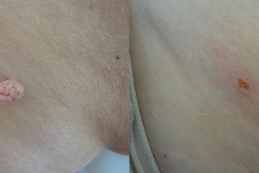 Laserová dermatologie před a po - 732597