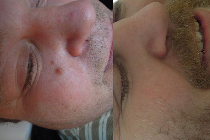 Laserová dermatologie před a po - 732599