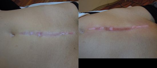 med laser narbe2