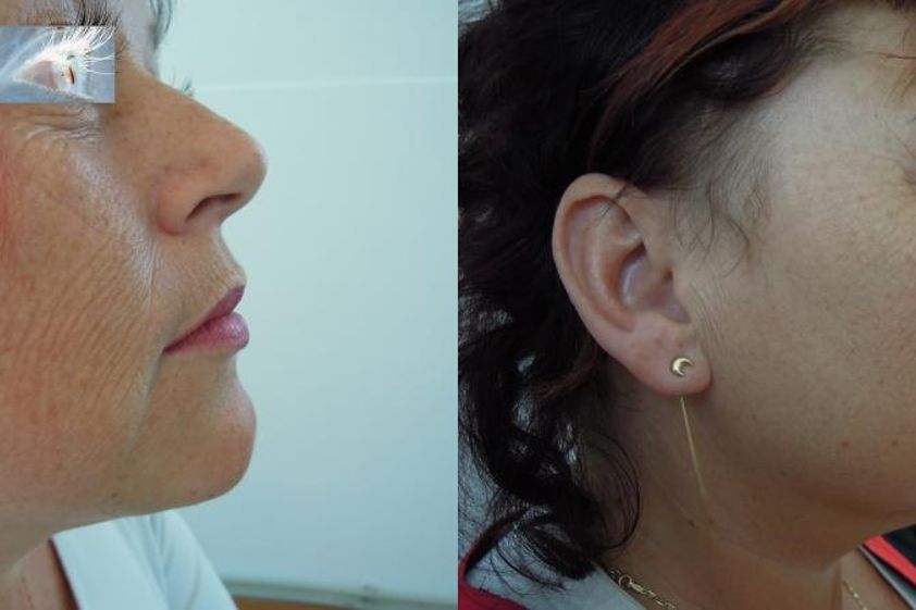 Frakční laser před a po - 732601