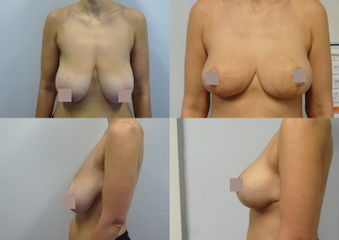 Zmenšení prsou - Body klinika plastické chirurgie