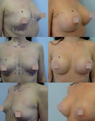 Zvětšení prsou - Body klinika plastické chirurgie