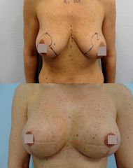 Zmenšení prsou - Body klinika plastické chirurgie