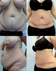 Abdominoplastika - Body klinika plastické chirurgie