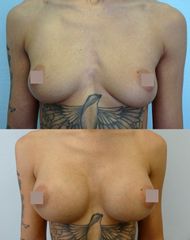 Zvětšení prsou - Body klinika plastické chirurgie