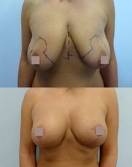 Modelace prsou - Body klinika plastické chirurgie