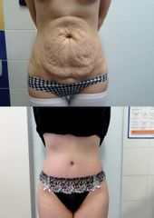 Abdominoplastika - Body klinika plastické chirurgie