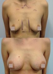 Zvětšení prsou - Body klinika plastické chirurgie