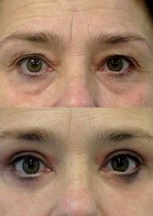 Operace očních víček - Body klinika plastické chirurgie