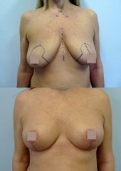 Modelace prsou - Body klinika plastické chirurgie