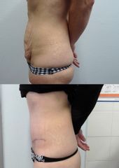 Abdominoplastika - Body klinika plastické chirurgie