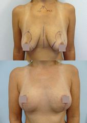 Modelace prsou - Body klinika plastické chirurgie