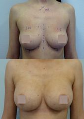 Zvětšení prsou - Body klinika plastické chirurgie