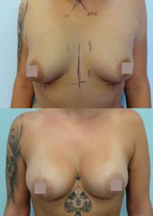 Zvětšení prsou - Body klinika plastické chirurgie