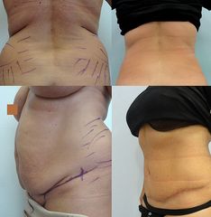 Abodminoplastika - Body klinika plastické chirurgie
